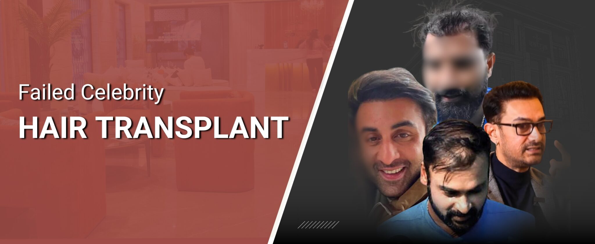 Why Celebrity Hair Transplants Often Fail:  Lessons from Dr. Shaiil Gupta, MD