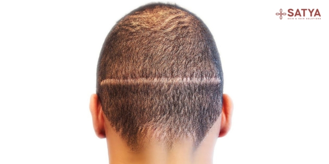 FUT Hair Transplant: A Comprehensive Guide to Safe, High-Yield Hair Restoration