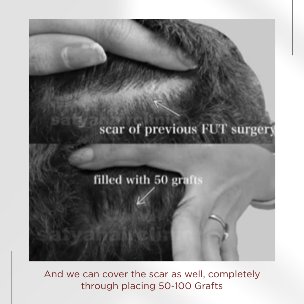 Scar Of FUT Surgery