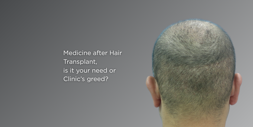 Can Hair Transplants Be Done Without Medicines?