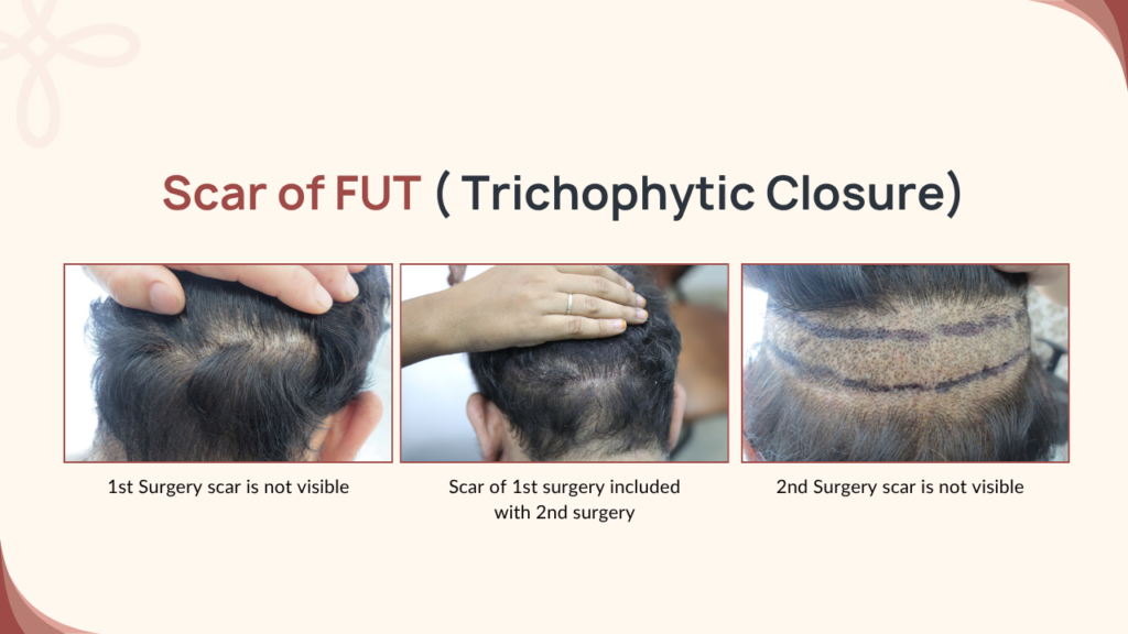 Second FUE Hair Transplant