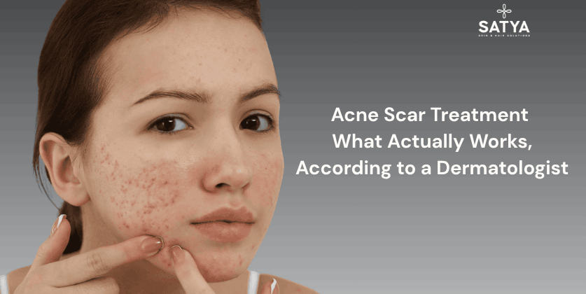 Acne Scars Treatment: The Definitive Guide by Satya Skin & Hair Solutions