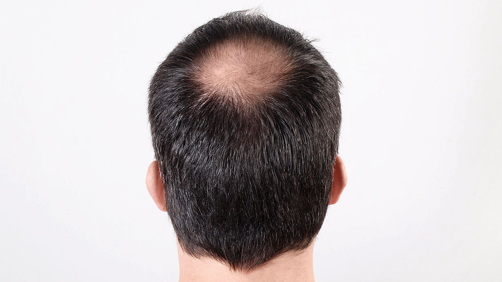 Why Gen Z Men in India Are Facing a Hair Loss Earlier ?