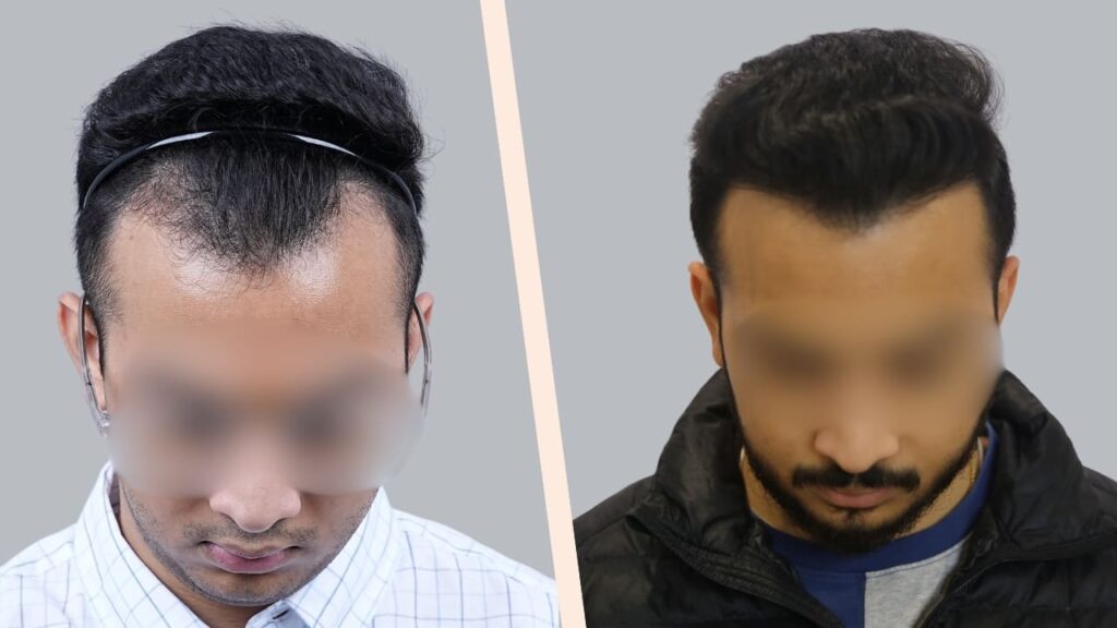 NORWOOD GRADE III Hair Transplant Result