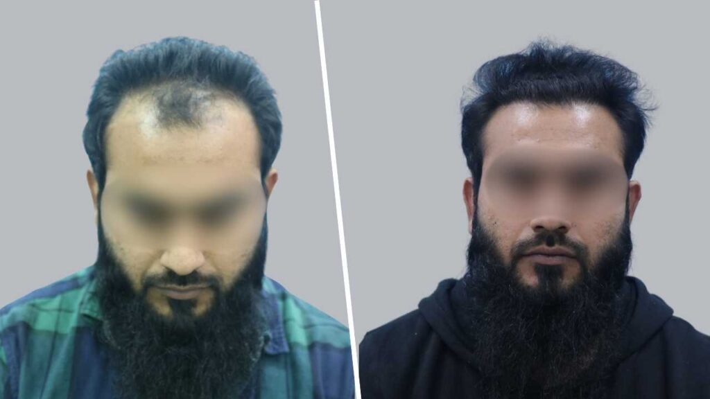 2500 Graft Hair Transplant | A Natural Hairline