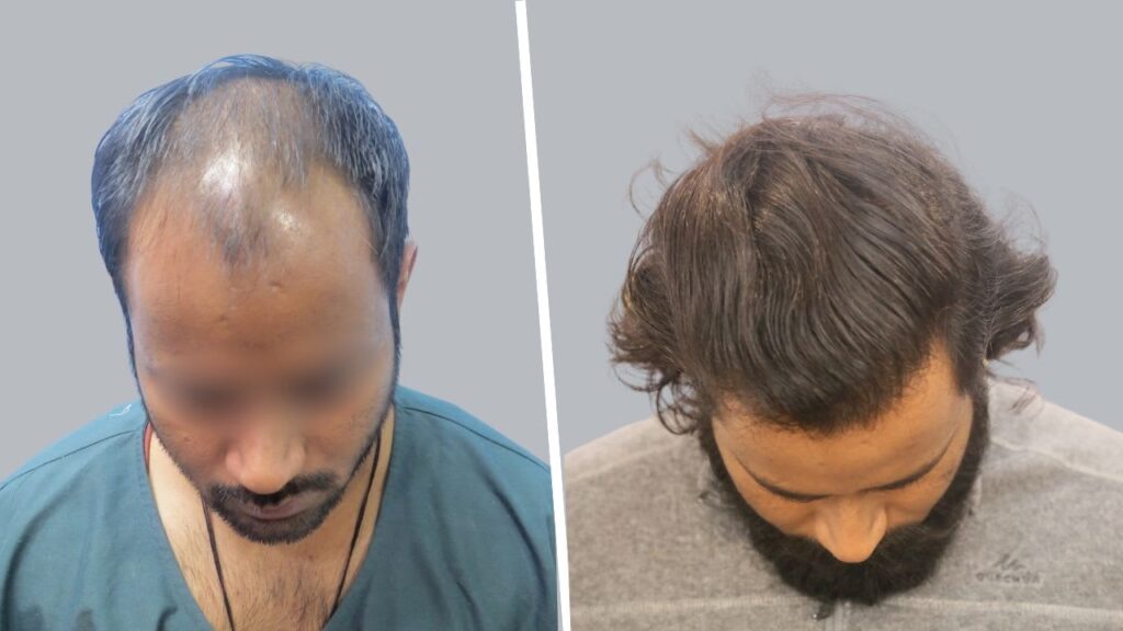 Grade 6 HAIR LOSS TREATMENT