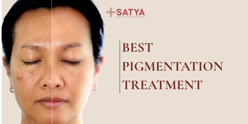 Treatment for Pigmentation