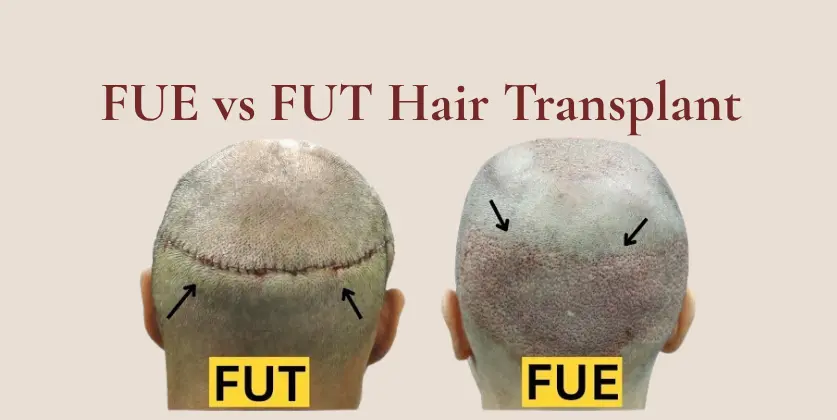 FUE vs FUT Hair Transplant: Which Hair Transplant Is Right for You?