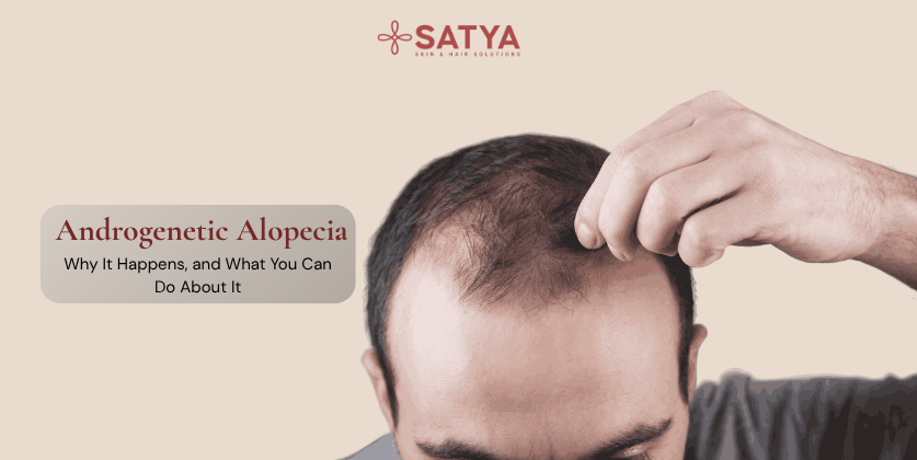 Androgenetic Alopecia