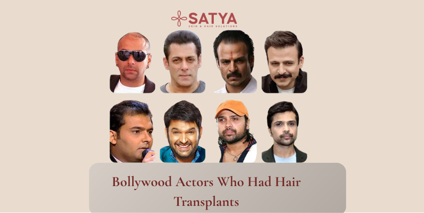 Celebrities Hair Transplant