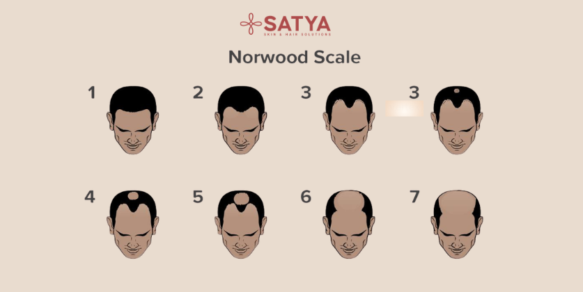 Male Pattern Baldness