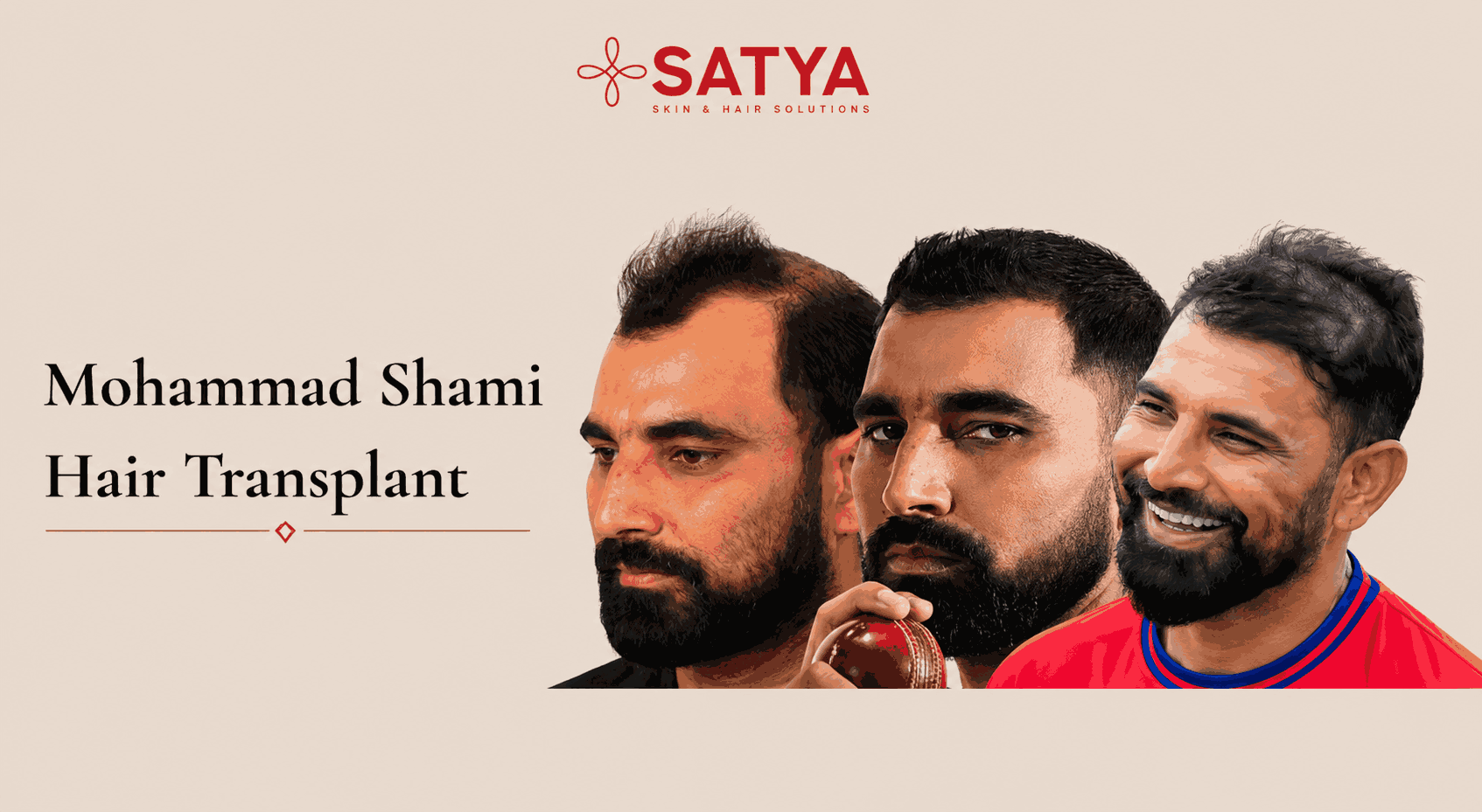 Mohammad Shami Hair Transplant