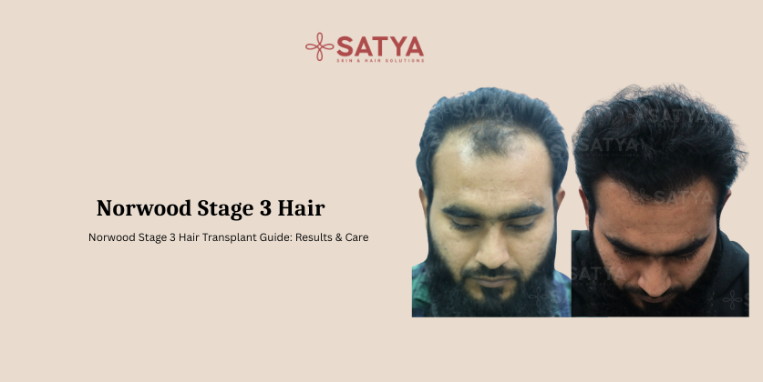 All About Norwood Stage 3 Hair Restoration: The Definitive 2026 Clinical Guide