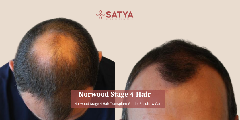 Norwood Stage 4 Hair Loss