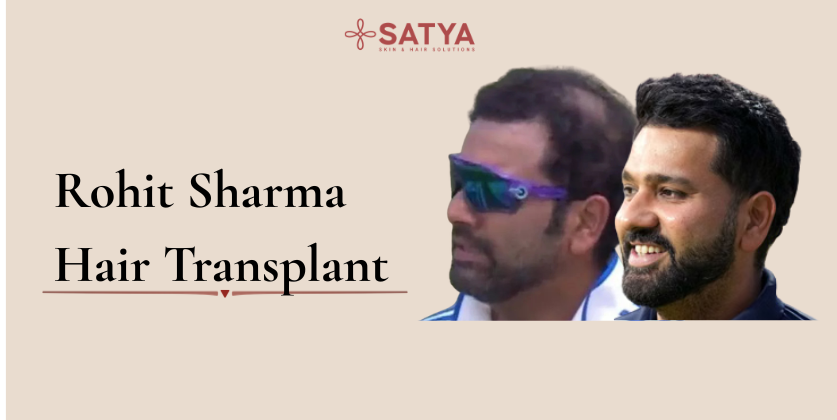 Rohit Sharma Hair Transplant