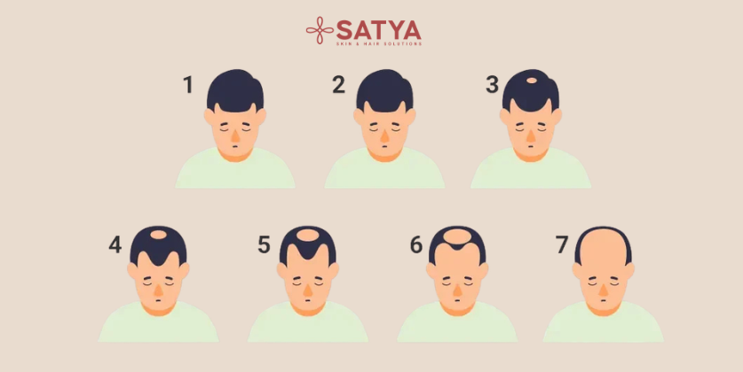 The 7 Stages of Hair Loss
