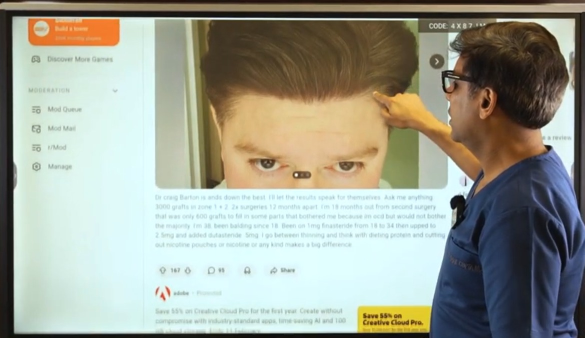 The Hidden Truth Behind Hair Transplant Results on Reddit
