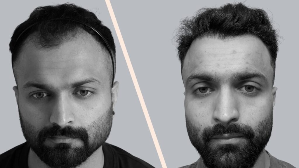Norwood Stage 3 Hair Restoration