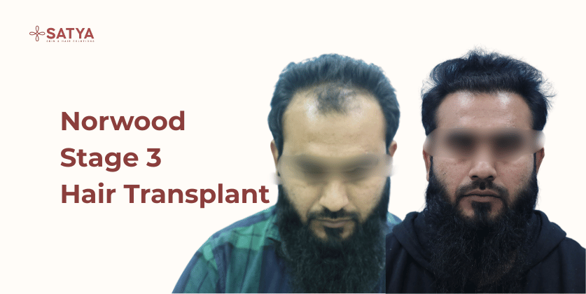 All About Norwood Stage 3 Hair Restoration: The Definitive 2026 Clinical Guide