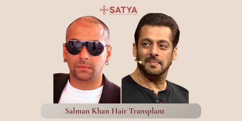 Salman Khan Hair Transplant