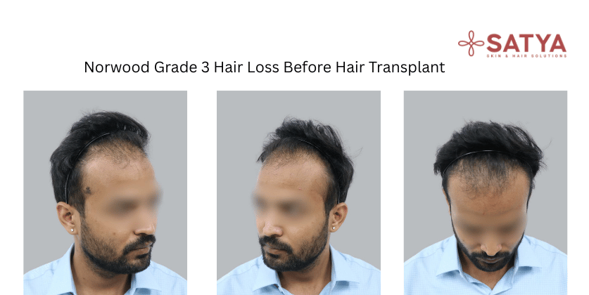 Norwood Grade 3 hair loss patient before hair transplant treatment showing receding hairline and temple recession