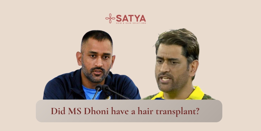 MS Dhoni Hair Transplant