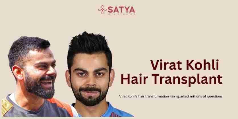 Virat Kohli Hair Transplant: Facts & Expert Analysis