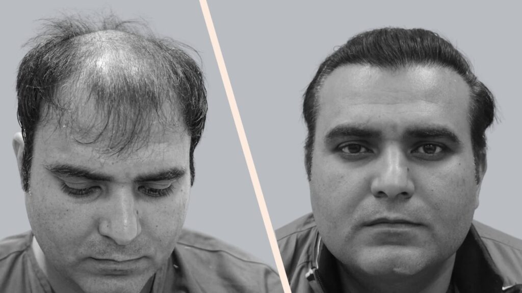 Norwood 5 Hair Transplant