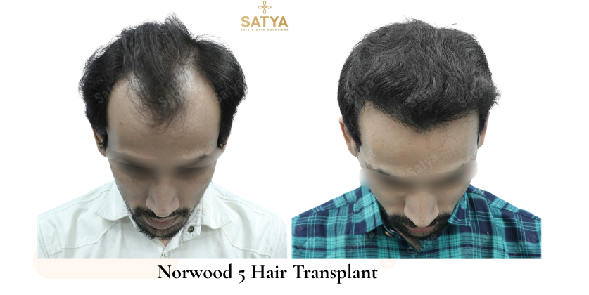 Norwood 5 Hair Transplant: A Doctor’s Guide to Treating Stage 5 Baldness