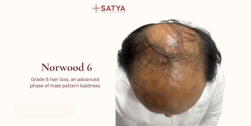 Norwood 6 Hair Transplant: Best Option For Treating Advanced Hair Loss