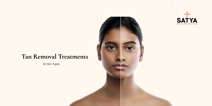 Tan Removal Treatments