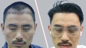 Repair Hair Transplant 