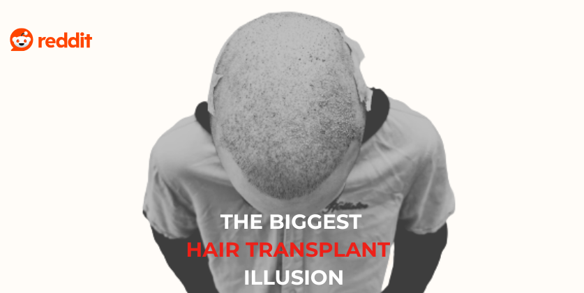 Reddit Hair Transplant Review: Did the Surgery Work or Was It the Medicine?