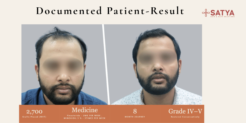 Norwood 6 Hair Transplant