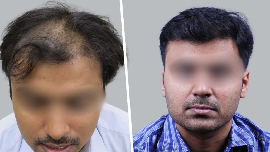 Crown Hair Transplant Result