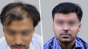 Crown Hair Transplant