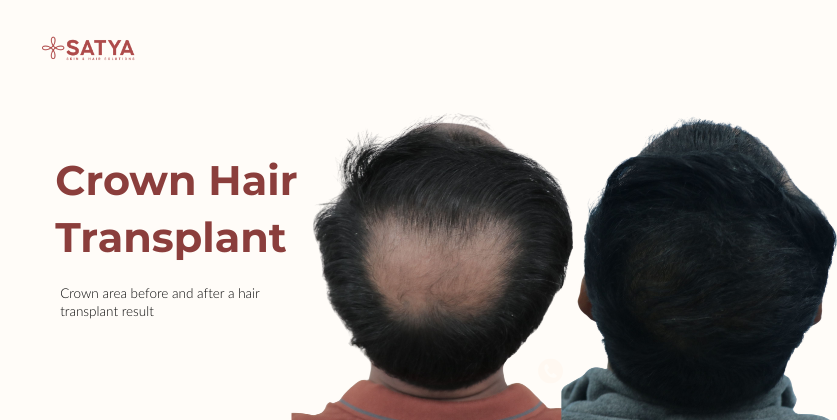 Crown Hair Transplant: Everything You Need to Know