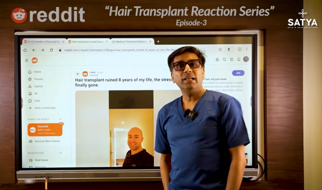Finasteride Really Mandatory After a Hair Transplant