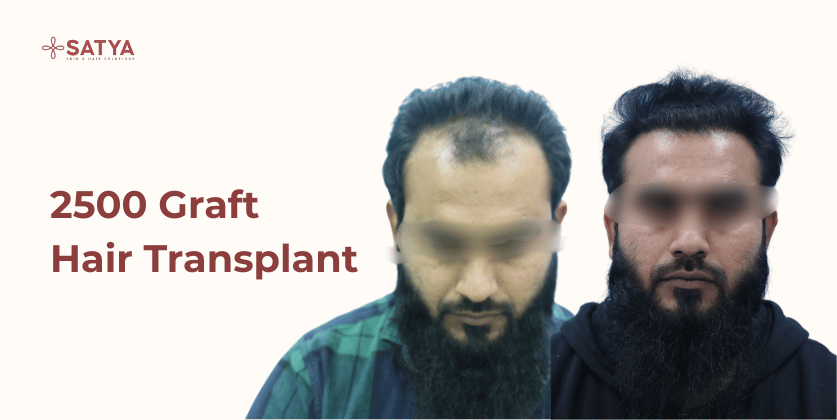 Recreating a Completely Natural Hairline: A 2500 Graft Hair Transplant Journey at Satya