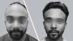 Hair Transplant Result