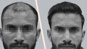 Best hair transplant Result