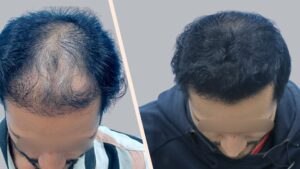 Best Hair Transplant