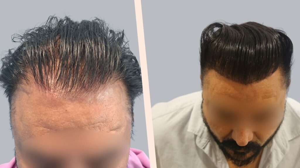 Synthetic Hair Transplant Result