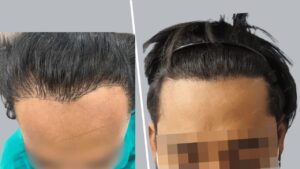 Repair Hair Transplant Result
