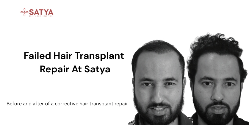 Repair Hair Transplant: How to Fix a Failed or Unnatural Result