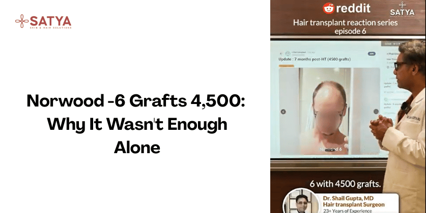 4,500 Grafts, Norwood Grade 6, Still Visible Gaps, Here’s Why