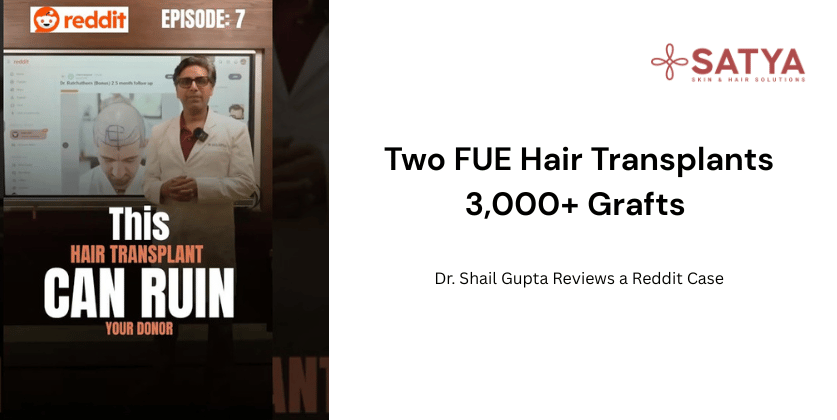Two FUE Hair Transplants and Over 3,000 Grafts: Dr. Shail Gupta Reviews a Reddit Case