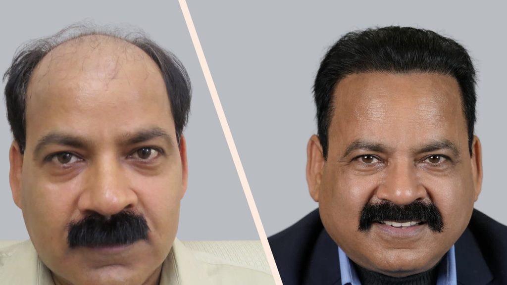 11 Year Sustained Hair Transplant Result
