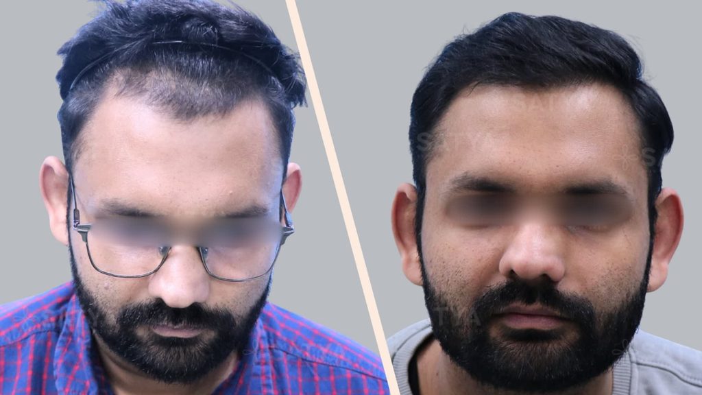 12 month Hair Transplant Result