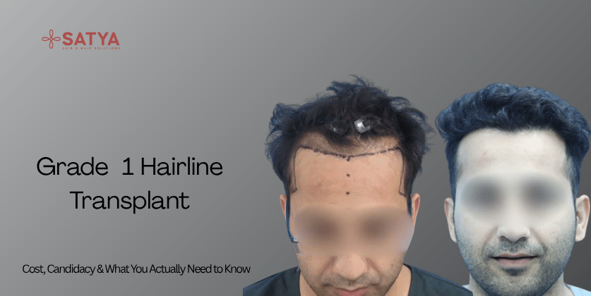 Grade 1 Hairline Transplant: Cost, Candidacy & What You Actually Need to Know (2026)